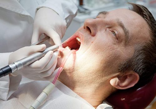 détartrage-dentaire