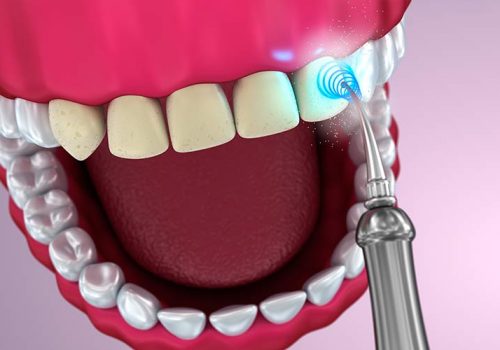 ultrason détartrage-dentaire
